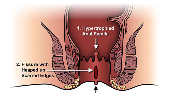 Anal Fissures