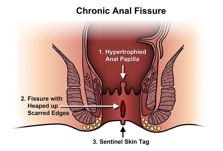 Anal Fissures