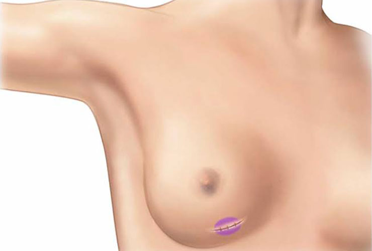 Breast Lump Surgery