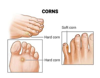 corn-foot