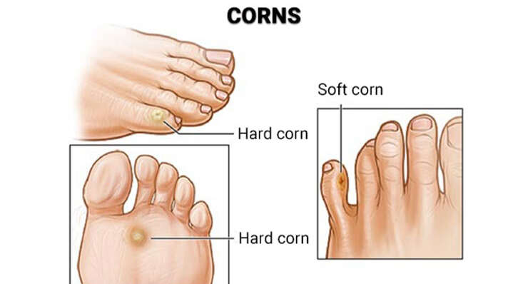 Corn Foot