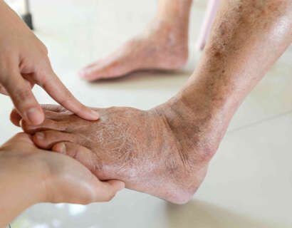 diabetic-foot