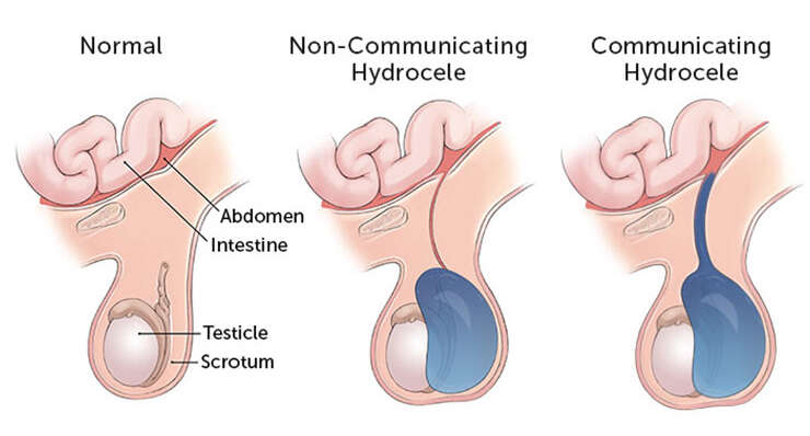 Hydrocele