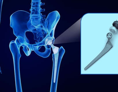 joint-replacement-surgeries