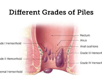 piles