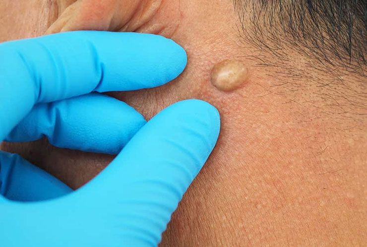 Sebaceous Cyst