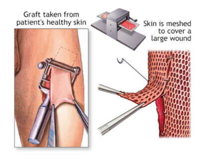 skin-grafting