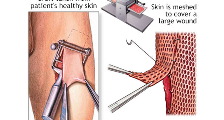 Skin Grafting