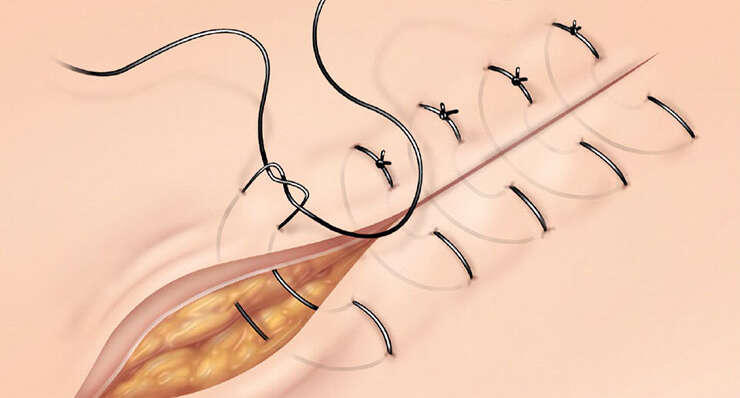 Suturing