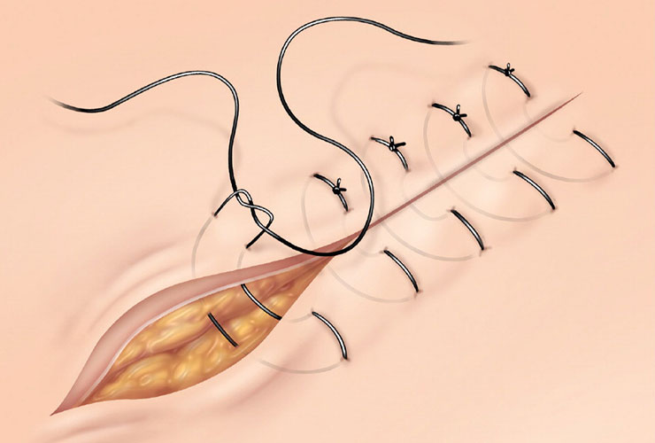 Suturing