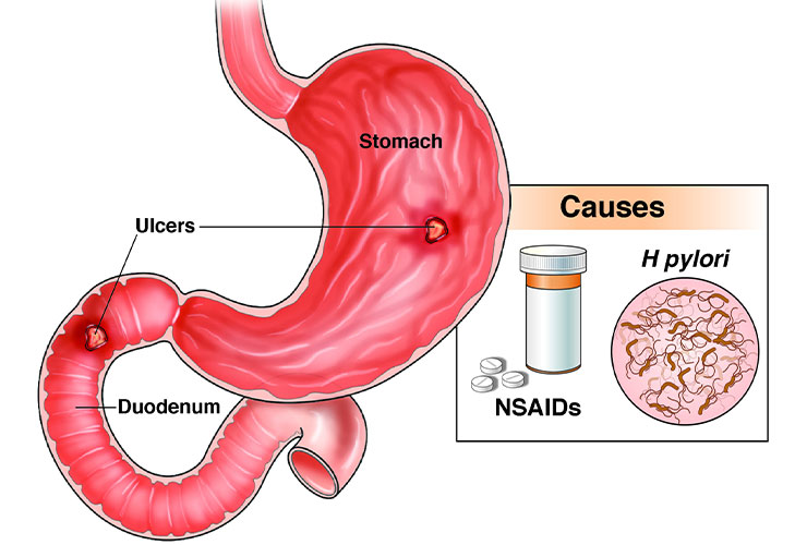 Ulcers SATVIC