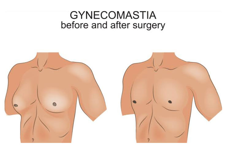Gynaecomastia surgery